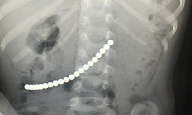 Дитина проковтнула магніти, Телеграм / Mash