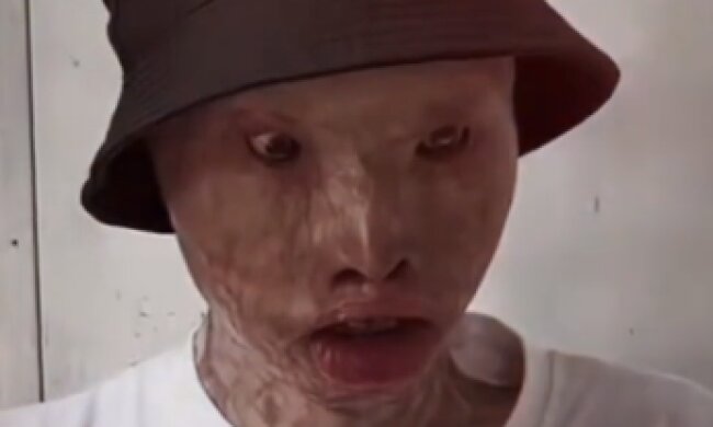 Парень пожертвовал красотой ради спасения любимой из пламени: она его бросила