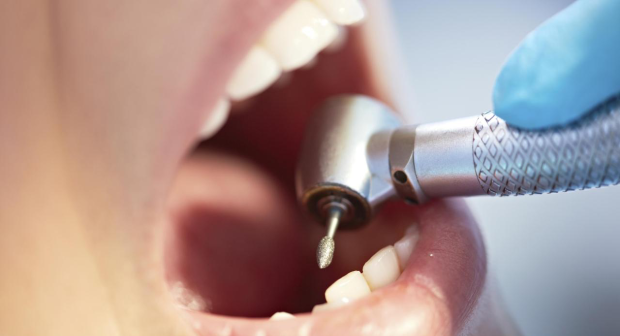 Бампер вместо пломбы: стоматологи будут лечить зубы по-новому