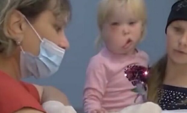 Маленька українка з подвійним обличчям стала звичайною дівчинкою, унікальні кадри після операції
