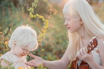 Чарівні сестрички-альбіноси замилували світ унікальною красою: як порцелянові ляльки