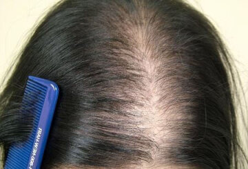 Облысение. Фото Сеть Медицинских Центров МСС