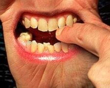 За откушенное ухо депутату «светит» 2 года тюрьмы