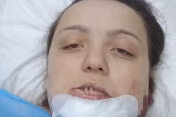 Родима пляма поставила під загрозу життя багатодітної матері: "Позаду три операції, попереду - ще дві"