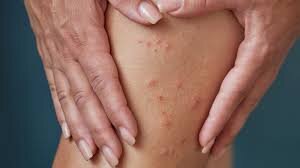 Укус насекомого. Фото Украинская правда