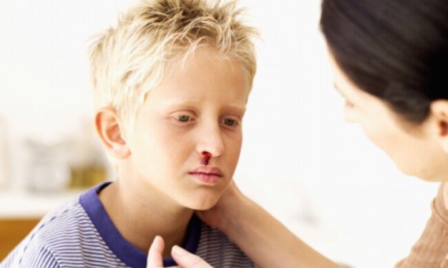 Носовое кровотечение: фото из свободных источников