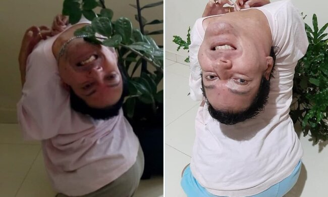 Хлопець з перевернутою головою рік не виходив з дому: "Визволи мене від цієї проклятої хвороби"