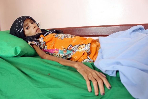 Шкіра, як папір: інтернет шокували фотографії дівчинки, що постраждала від війни