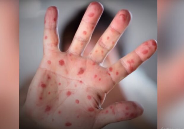 В Україні зафіксовано випадки інфекційного захворювання: хто у групі ризику