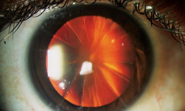 Жінка з зіницею-піцою: офтальмологи зіткнулися з непередбаченими наслідками старої операції