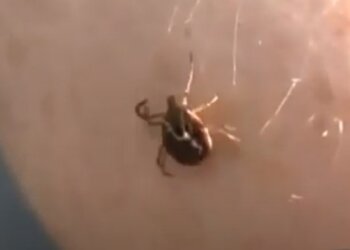 Укус клеща. Фото: Youtube