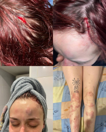 Дівчина, побита працівником ТЦК. Фото: "Думська"