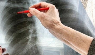 Киевлян зовут бесплатно провериться на туберкулез и ВИЧ