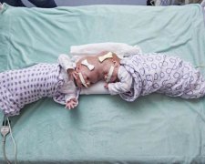 У США успішно роз'єднали рідкісних сіамських близнюків