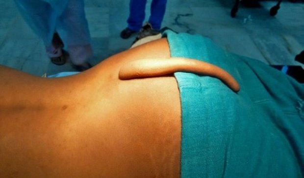 Индийские хирурги удалили юноше  18-сантиметровый хвост (видео)