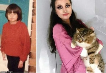 С таким диагнозом многие не доживают и до 5 лет, а она отметила 35: девушка имеет кожу бабочки и страдает каждый день