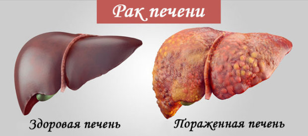 Новые методы лечения рака печени