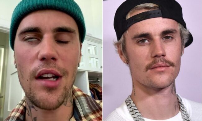 Лицьовий параліч Джастіна Бібера може означати, що у нього залишаться симптоми