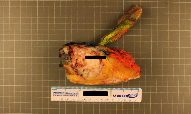 Хордома: генетики наблизилися до розгадки таємничої форми раку