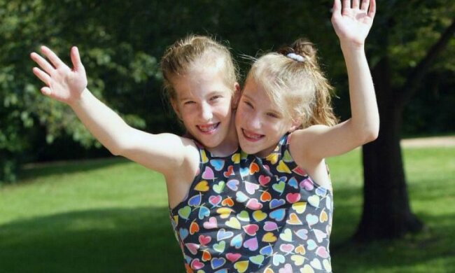 Життя на двох: як виглядають сіамські близнючки в 28 років