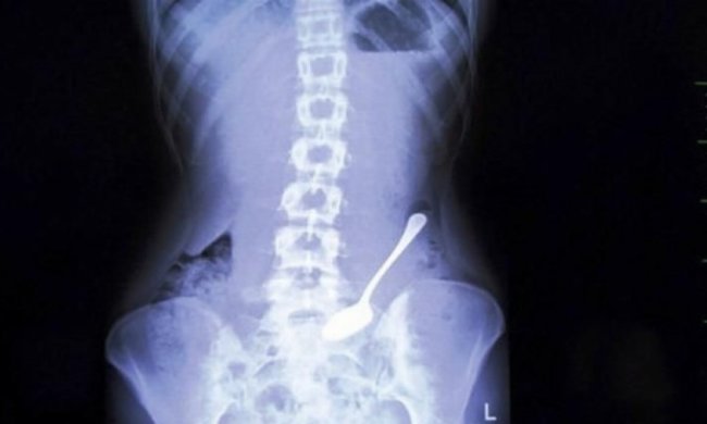 Із шлунку студентки витягли 14-сантиметрову ложку