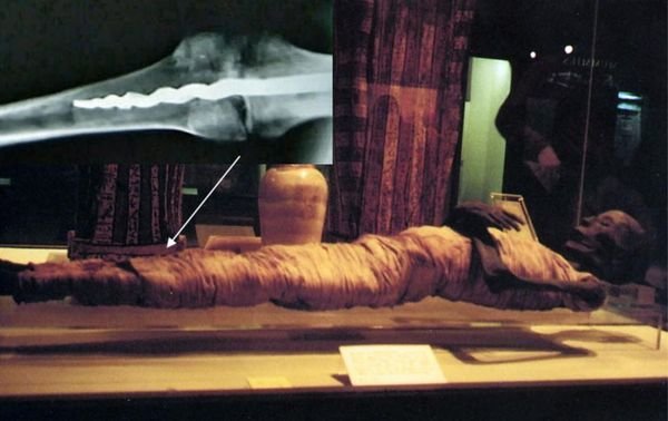 Древняя мумия "рассказала" исследователям о чудесах медицины: такого не ожидал увидеть никто