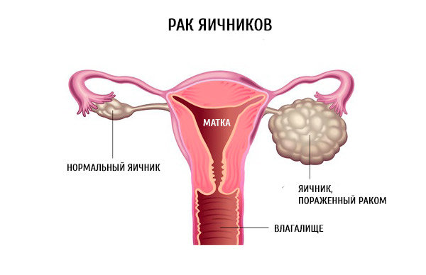 Кольпорафия с леваторопластикой