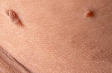 Папіломи, кадр з відео