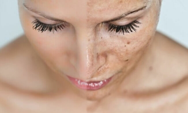 пігментні плями