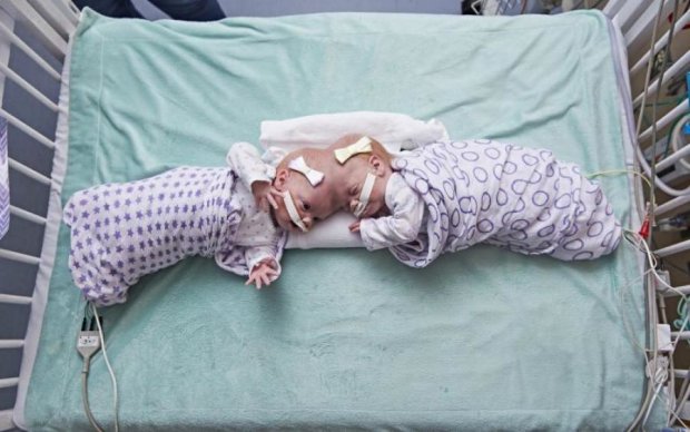 В США успешно разъединили редких сиамских близнецов