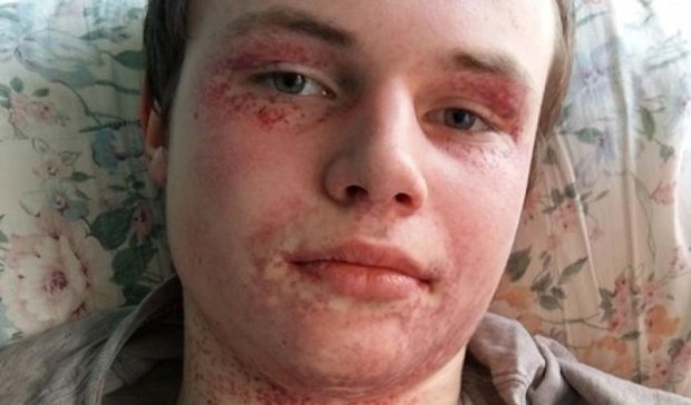 Тело 16-летнего харьковчанина покрылось волдырями после лечения (фото)