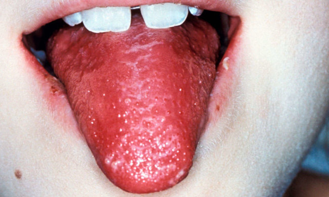 Хвороба Кавасакі: все, що потрібно знати про дитячу лихоманку