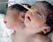 Двоголова дитина померла після народження