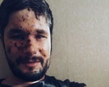 Покалічений під Авдіївкою британець розповів про злощасний обстріл