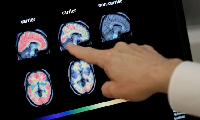 Хвороба Альцгеймера - більше не вирок: знайдено ліки, які подарують шанс мільйонам людей