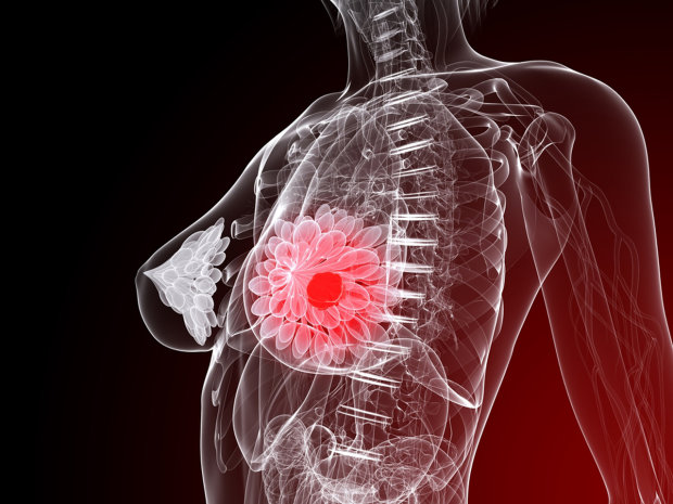 Онкологи дали відсіч найагресивнішому раку грудей