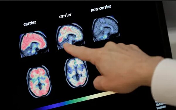 Сканування мозку пацієнтів із деменцією та без неї, фото: Matt York/AP