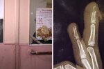 Дівчинка зламала палець у школі: Суспільне