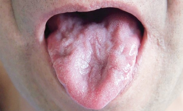 На кінчику язику: панкреатит навчилися діагностувати по бактеріям у роті
