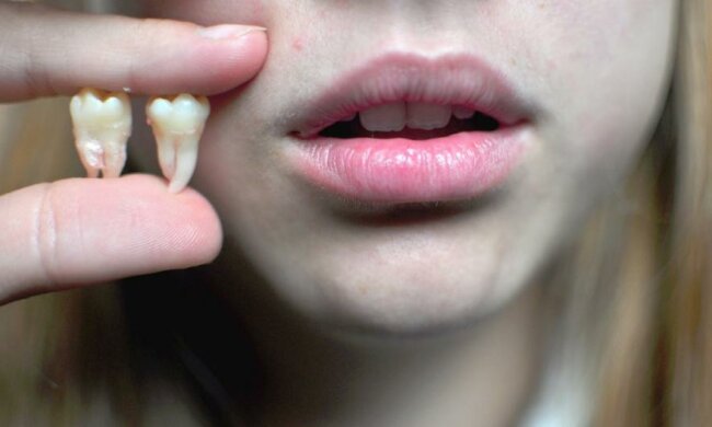 Зуби мудрості: залишити не можна видалити