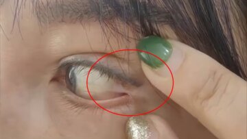 Глаз женщины пришили к веку