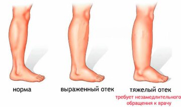 Отек ног: источник: fdoctor.ru