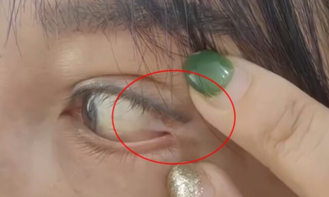 Глаз женщины пришили к веку