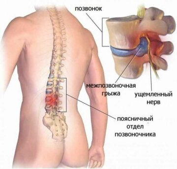 біль у попереку