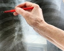 Киян кличуть безкоштовно перевіритися на туберкульоз і ВІЛ