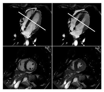 МРТ серця, фото: diagnosticimaging.com