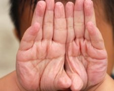 Чому шкіра на пальцях зморщується від води