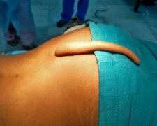 Індійські хірурги видалили юнакові 18-сантиметровий хвіст (відео)