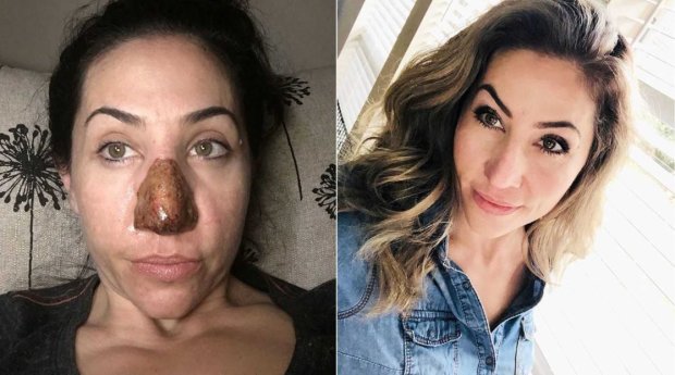 Подпирала ночью кончик носа, чтоб не задохнуться: неизвестная болезнь изуродовала женщину за 2 года