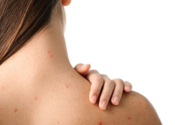 Прыщи на спине, изображение из свободных источников